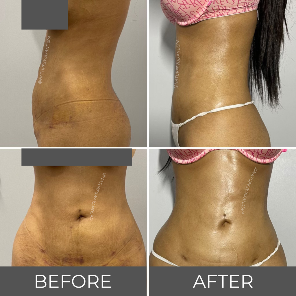 Body Contouring Package
