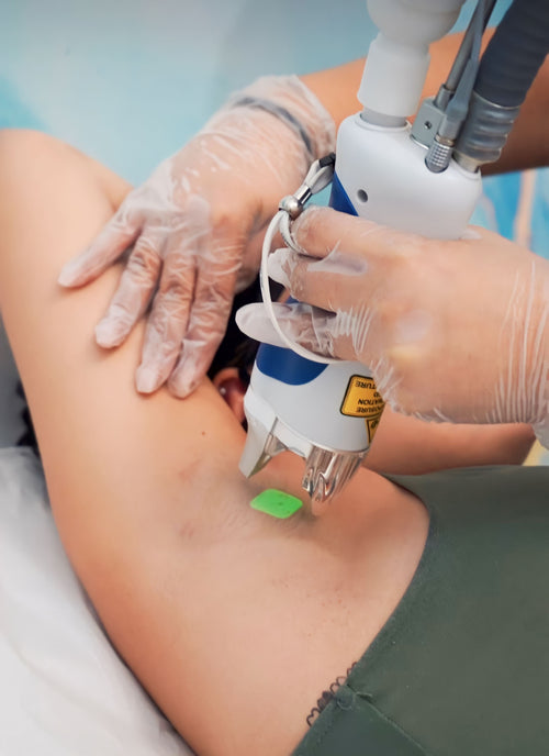 Laser hair removal treatment in Kissimmee using Splendor X technology at Nature’s Wax Med & Spa.
