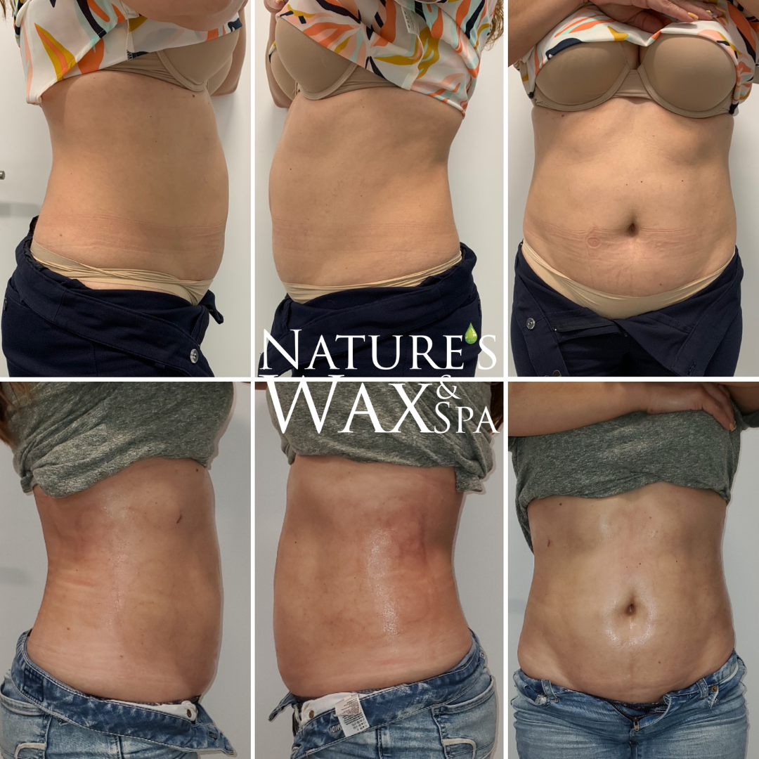 Body Contouring Package