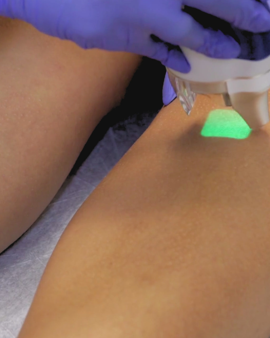 6 Sessions any medium area Laser Hair Removal